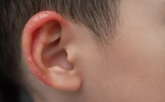 Child's ear with red inflamed skin and dry patches