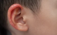 Child's ear with red inflamed skin and dry patches