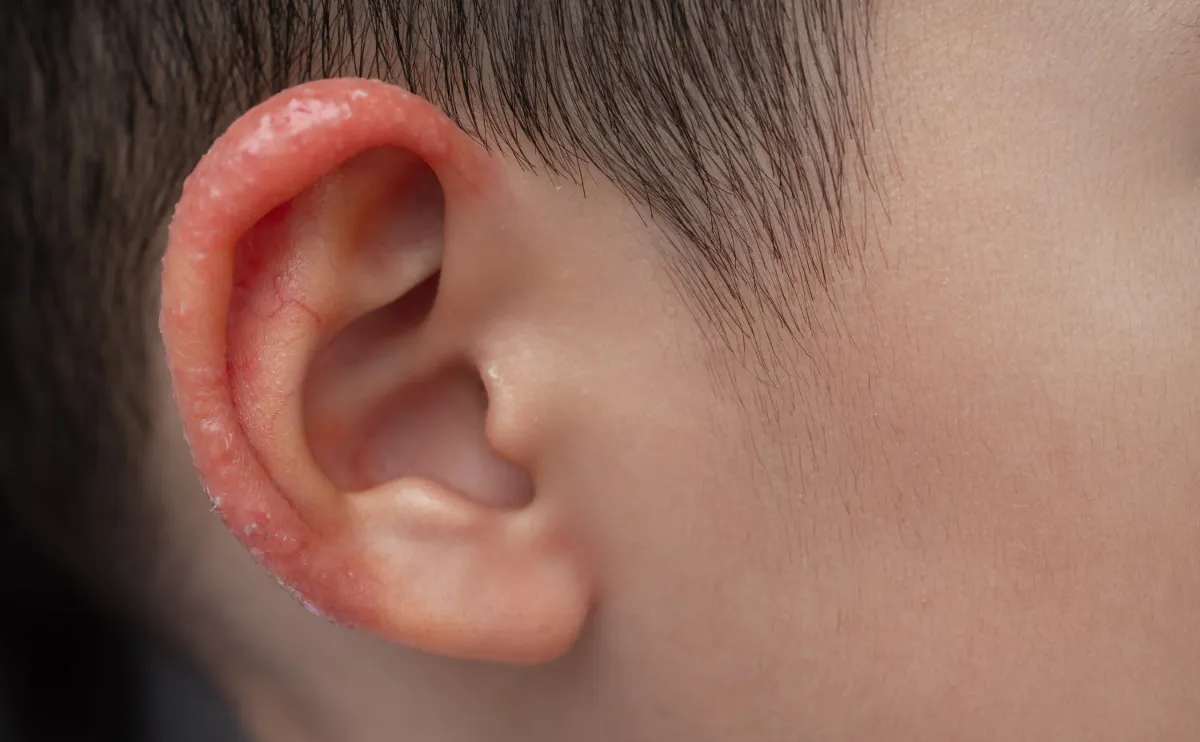 Child's ear with red inflamed skin and dry patches