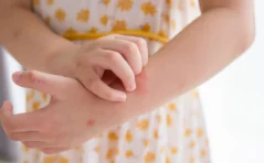 Picture of a little girl in a white and yellow dress scratching hives on her arm