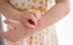Picture of a little girl in a white and yellow dress scratching hives on her arm